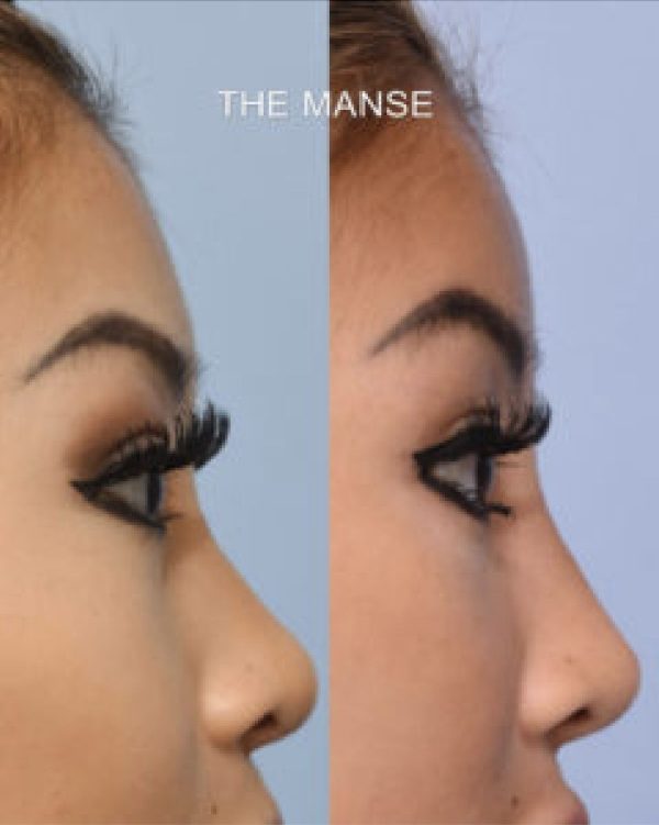 Before and after forehead shape treatment and other treatments